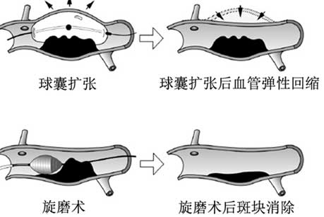 旋磨术示意图.jpg